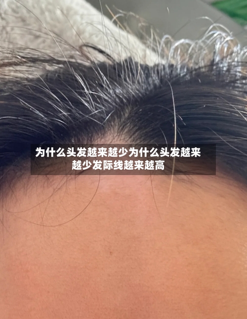 为什么头发越来越少为什么头发越来越少发际线越来越高