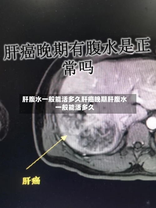 肝腹水一般能活多久肝癌晚期肝腹水一般能活多久