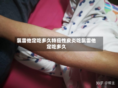 氯雷他定吃多久特应性皮炎吃氯雷他定吃多久