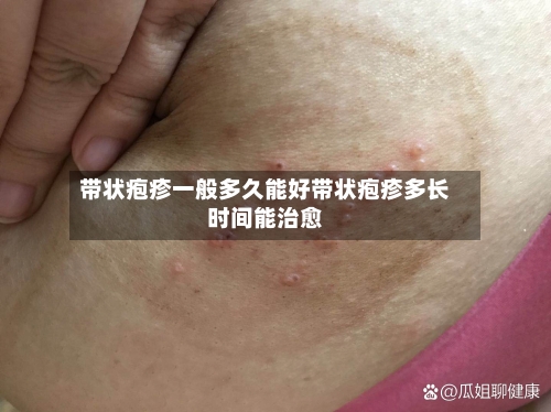 带状疱疹一般多久能好带状疱疹多长时间能治愈