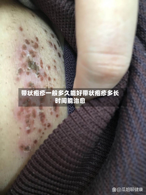 带状疱疹一般多久能好带状疱疹多长时间能治愈