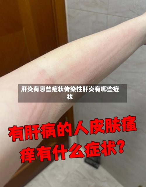 肝炎有哪些症状传染性肝炎有哪些症状