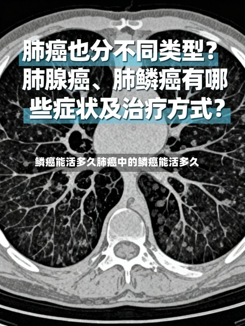 鳞癌能活多久肺癌中的鳞癌能活多久