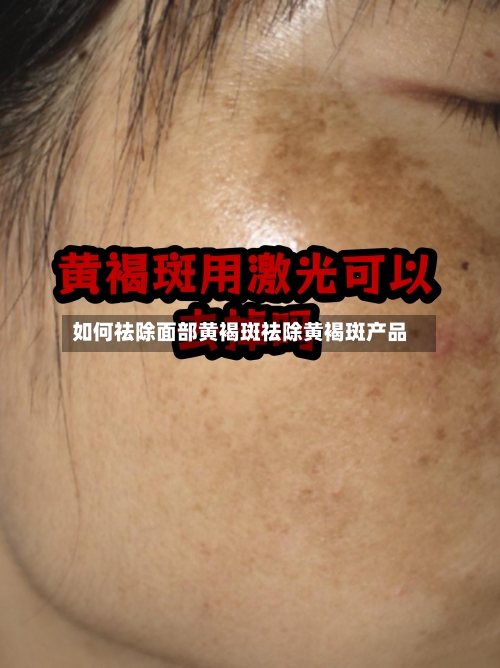 如何祛除面部黄褐斑祛除黄褐斑产品
